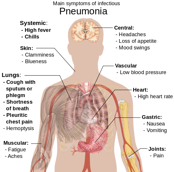 Detail Gambar Penyakit Pneumonia Nomer 33