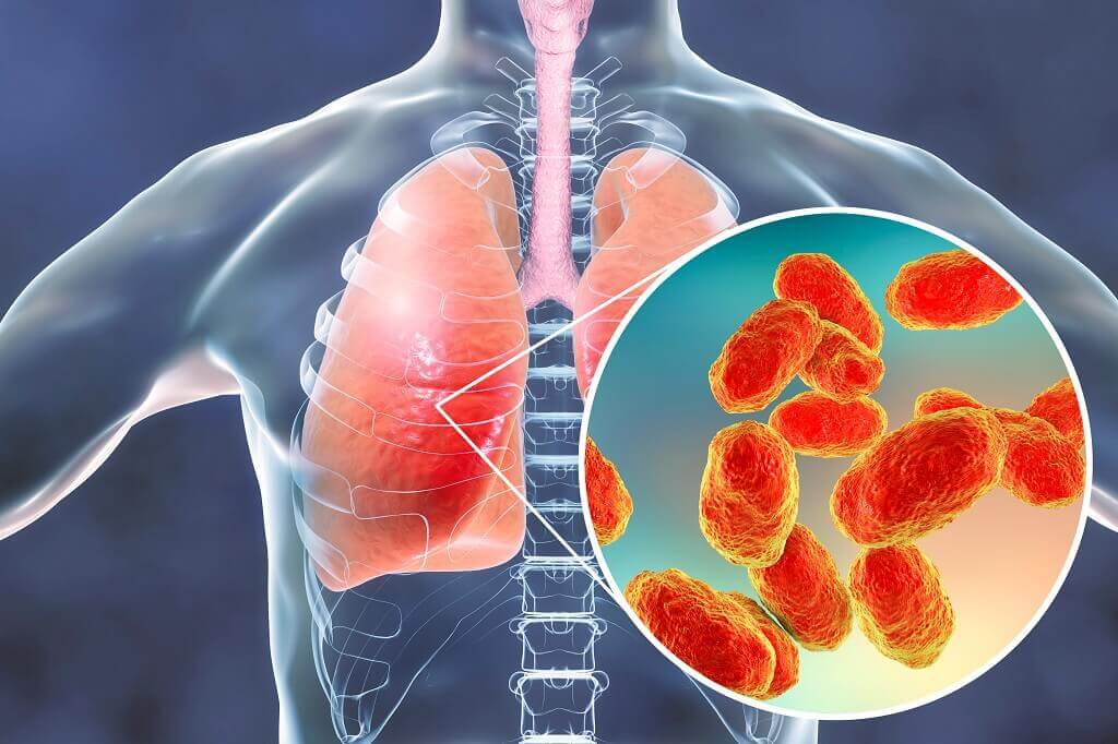 Detail Gambar Penyakit Pneumonia Nomer 8