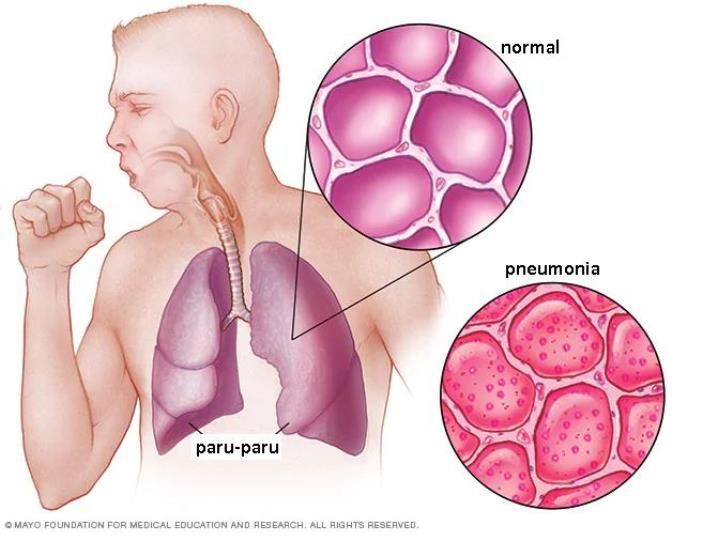 Detail Gambar Penyakit Pneumonia Nomer 10