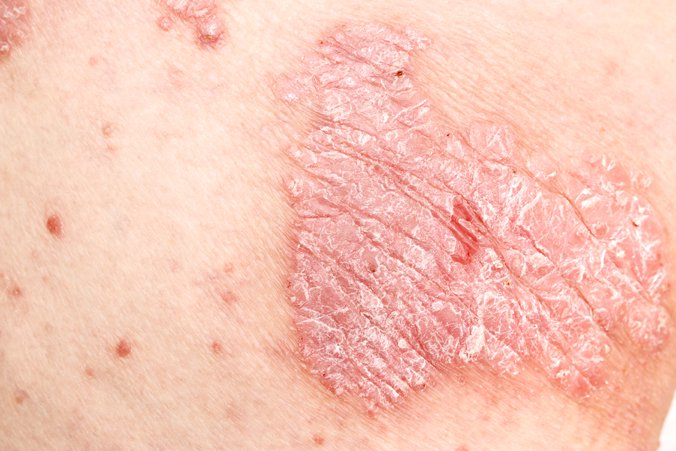 Detail Gambar Penyakit Psoriasis Nomer 35