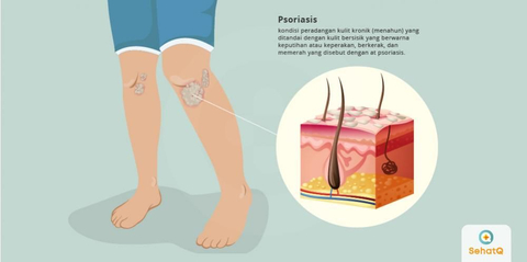 Detail Gambar Penyakit Psoriasis Nomer 43