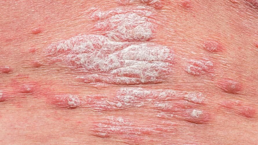 Detail Gambar Penyakit Psoriasis Nomer 44