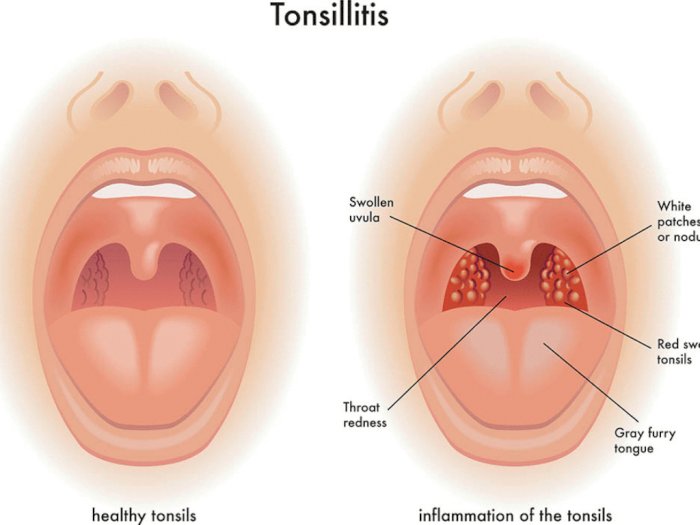 Detail Gambar Penyakit Radang Tenggorokan Nomer 9