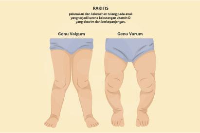 Detail Gambar Penyakit Rakhitis Nomer 20