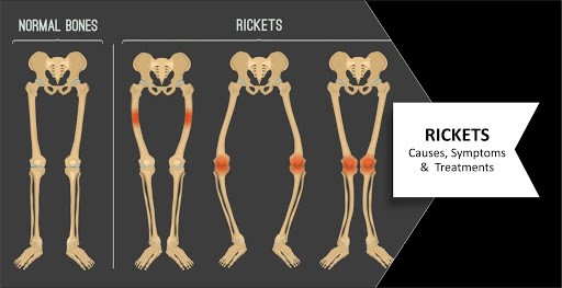 Detail Gambar Penyakit Rakhitis Nomer 4