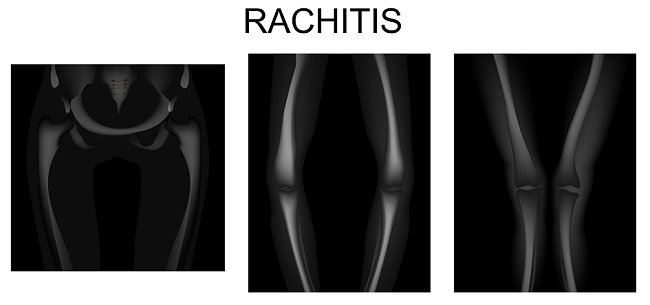 Detail Gambar Penyakit Rakhitis Nomer 29