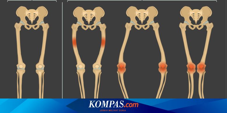 Detail Gambar Penyakit Rakhitis Nomer 32