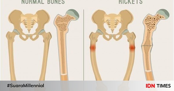 Detail Gambar Penyakit Rakhitis Nomer 9