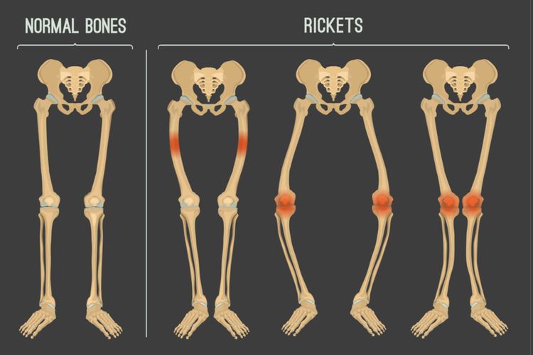 Detail Gambar Penyakit Rakitis Nomer 3