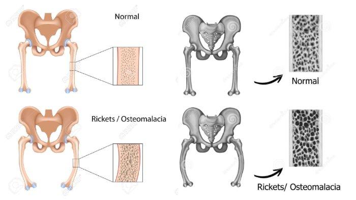 Detail Gambar Penyakit Rakitis Nomer 22