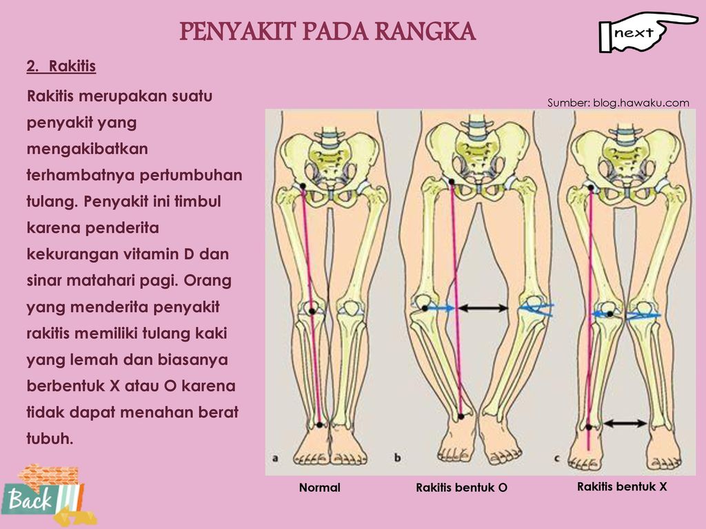 Detail Gambar Penyakit Rakitis Nomer 29