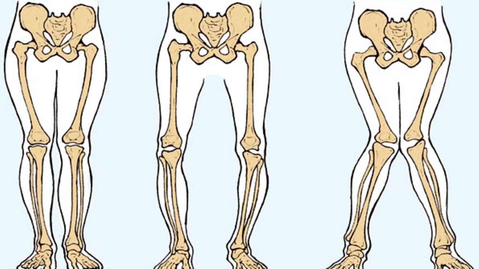 Detail Gambar Penyakit Rakitis Nomer 44