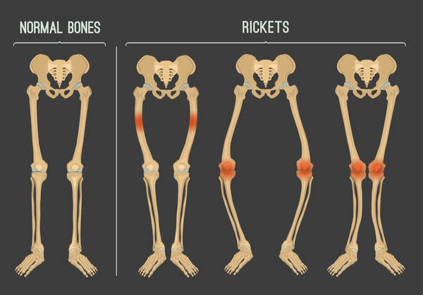 Detail Gambar Penyakit Riketsia Nomer 4