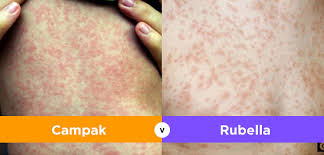 Detail Gambar Penyakit Rubella Nomer 22