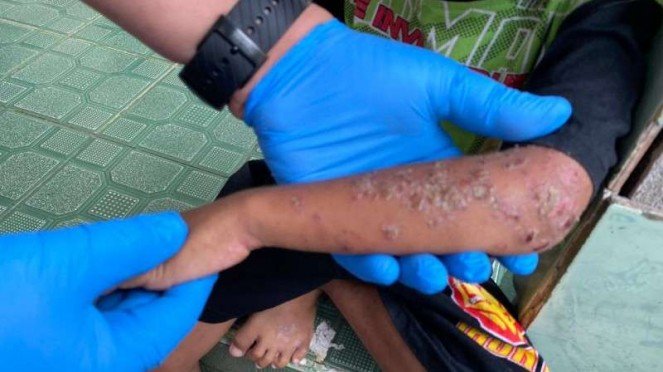 Detail Gambar Penyakit Scabies Nomer 9