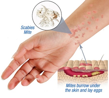 Detail Gambar Penyakit Scabies Nomer 10