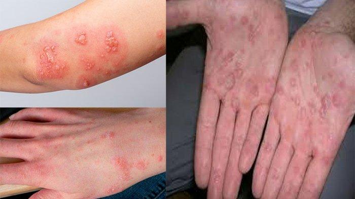 Detail Gambar Penyakit Scabies Nomer 2