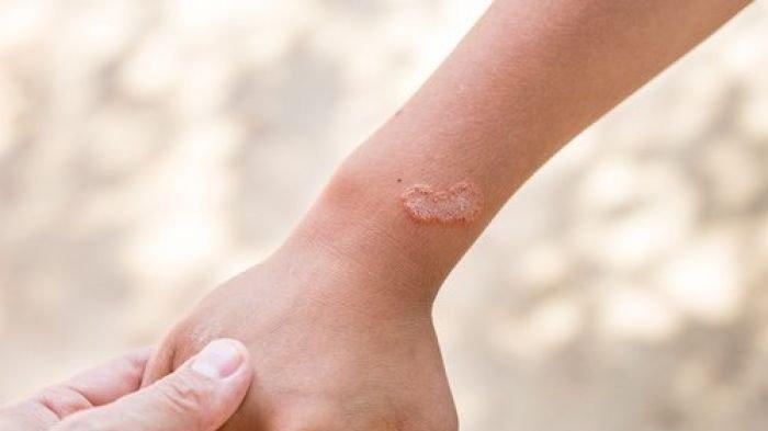 Detail Gambar Penyakit Scabies Nomer 22