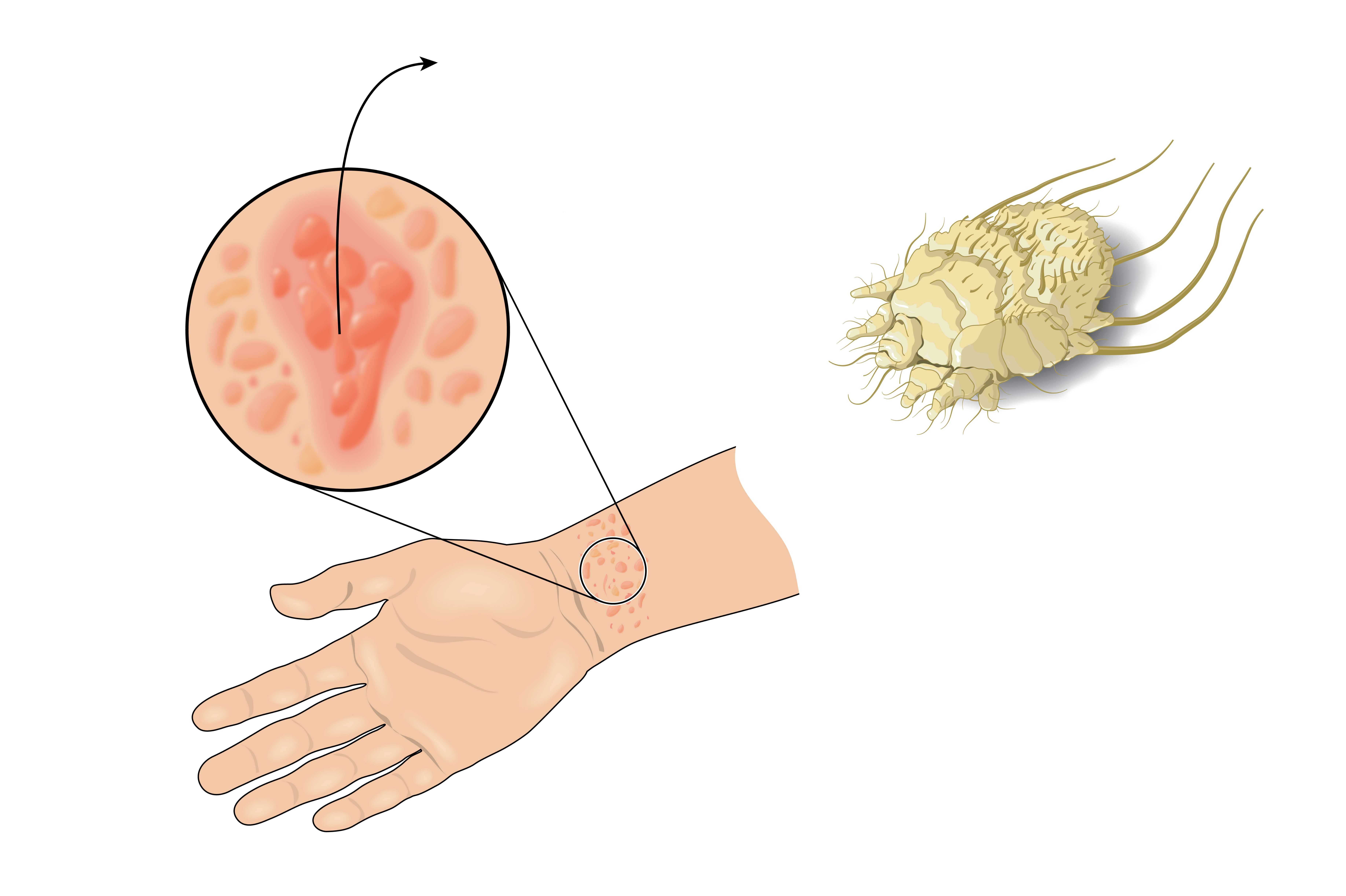 Detail Gambar Penyakit Scabies Nomer 25