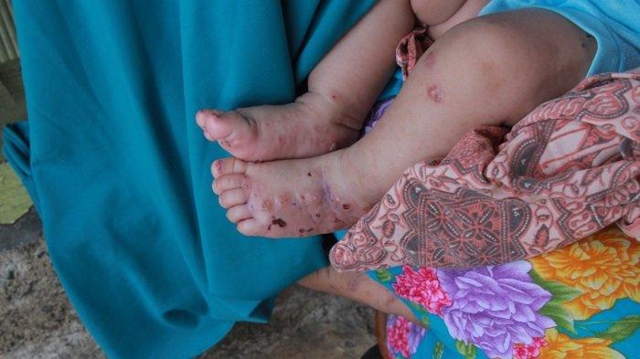 Detail Gambar Penyakit Scabies Nomer 26