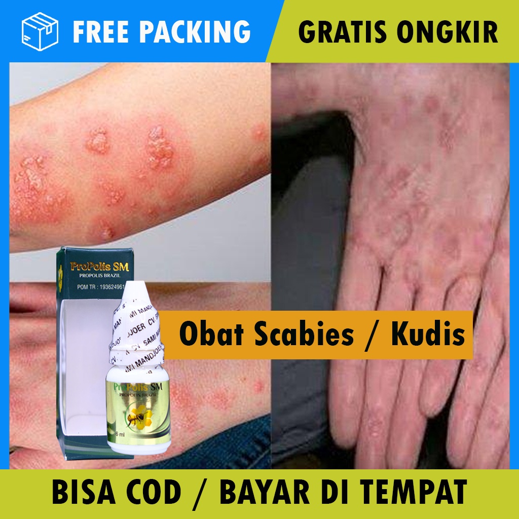 Detail Gambar Penyakit Scabies Nomer 35