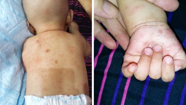 Detail Gambar Penyakit Scabies Nomer 37