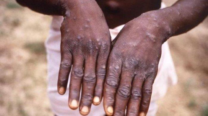 Detail Gambar Penyakit Scabies Nomer 45