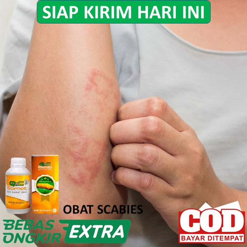 Detail Gambar Penyakit Scabies Nomer 46