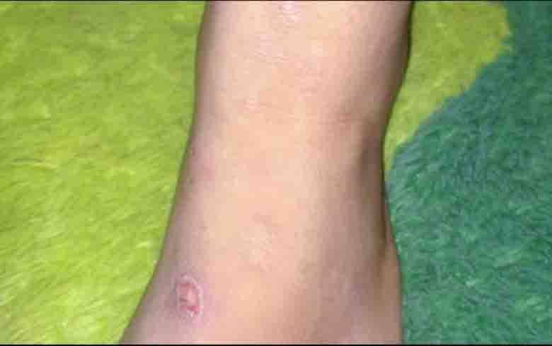 Detail Gambar Penyakit Scabies Nomer 49