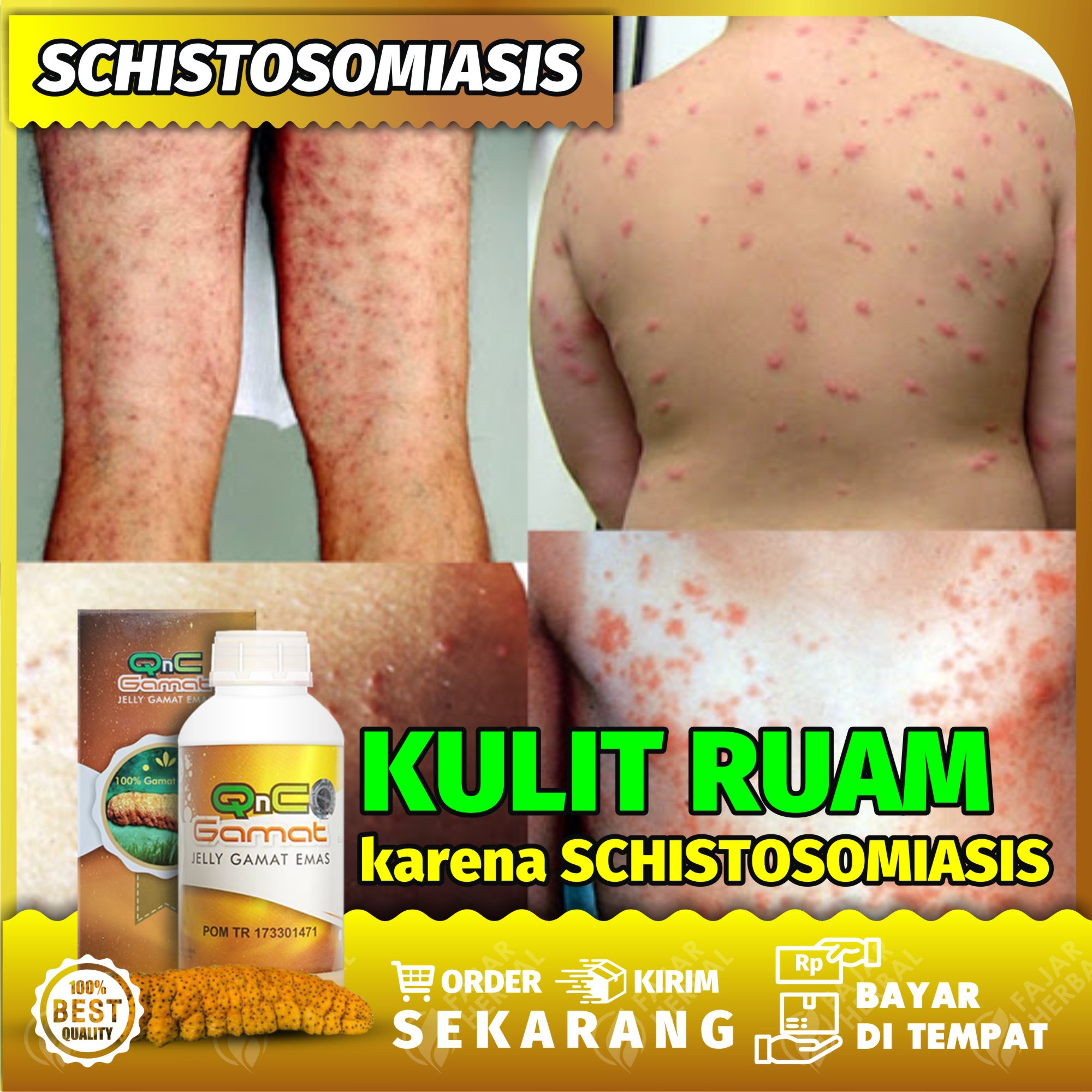 Detail Gambar Penyakit Schistosomoasis Nomer 35