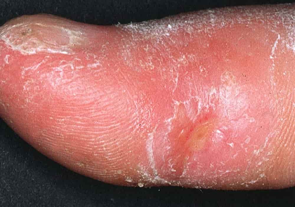 Detail Gambar Penyakit Scleroderma Nomer 18