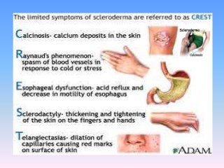 Detail Gambar Penyakit Scleroderma Nomer 49