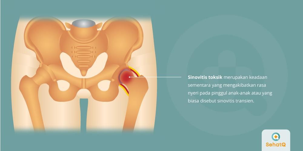 Detail Gambar Penyakit Sendi Nomer 48