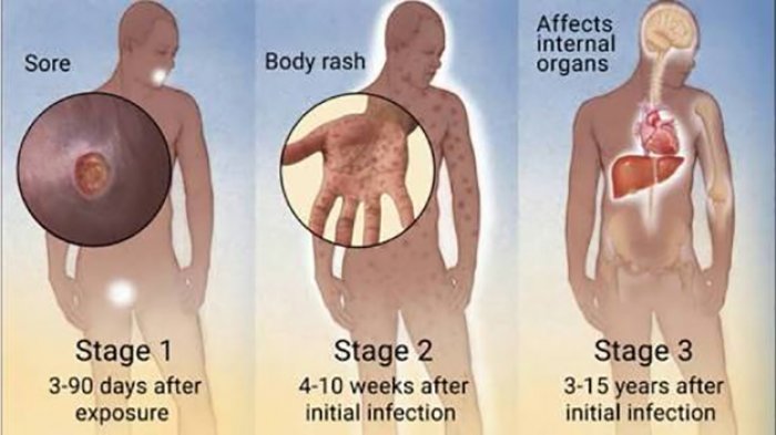 Detail Gambar Penyakit Siflis Nomer 4