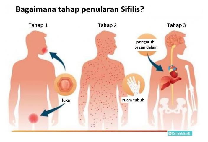 Detail Gambar Penyakit Siflis Nomer 5