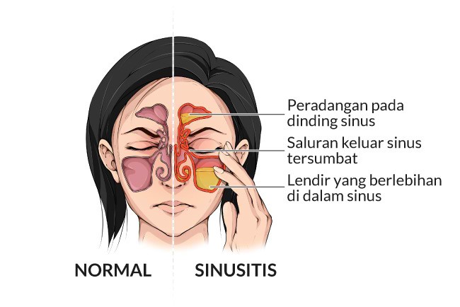 Gambar Penyakit Sinusitis - KibrisPDR