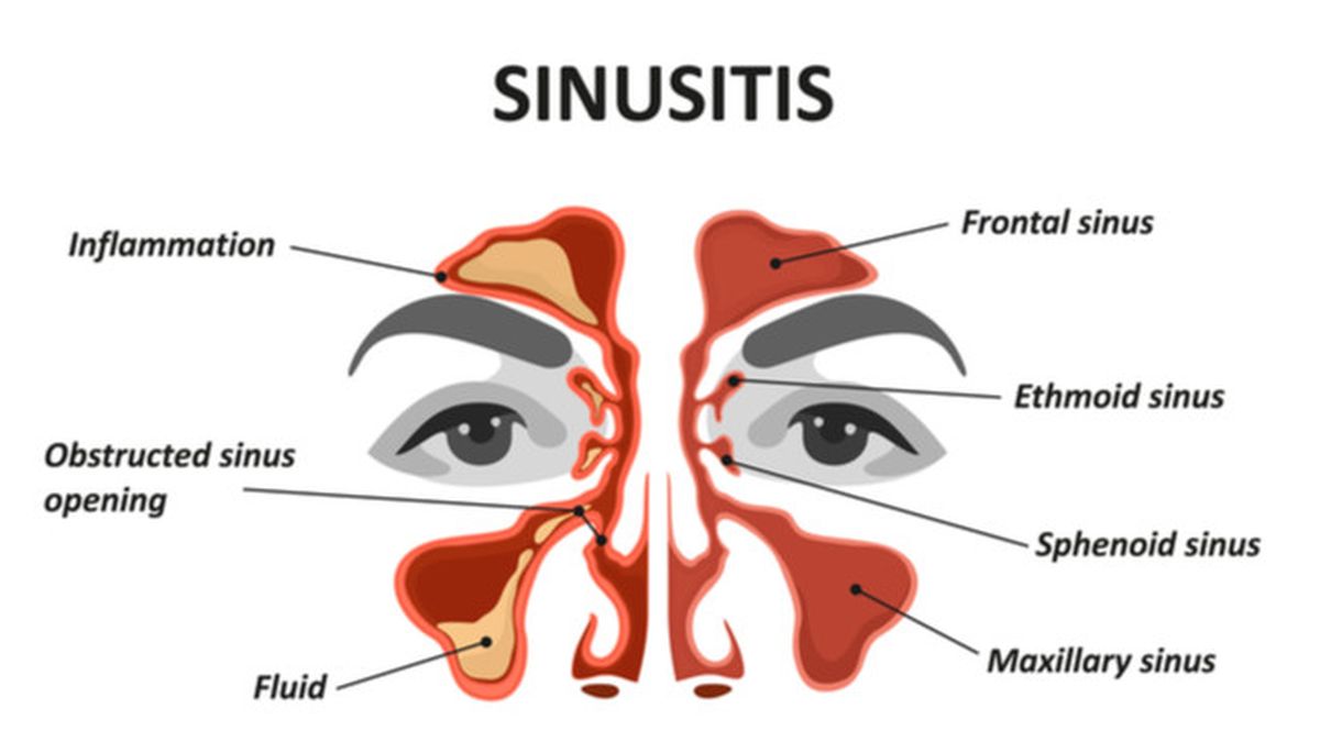 Detail Gambar Penyakit Sinusitis Nomer 2