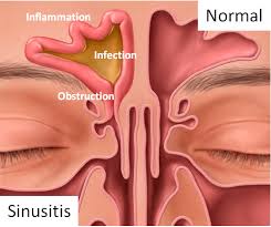 Detail Gambar Penyakit Sinusitis Nomer 37