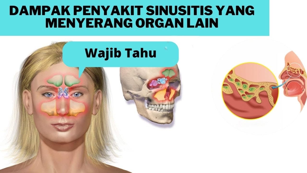 Detail Gambar Penyakit Sinusitis Nomer 45