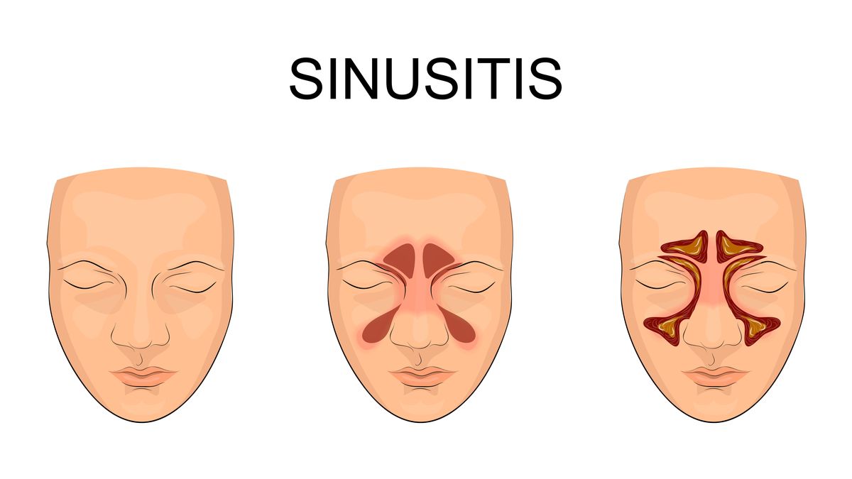 Detail Gambar Penyakit Sinusitis Nomer 47