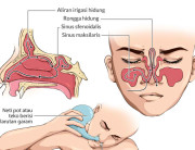 Detail Gambar Penyakit Sinusitis Nomer 49