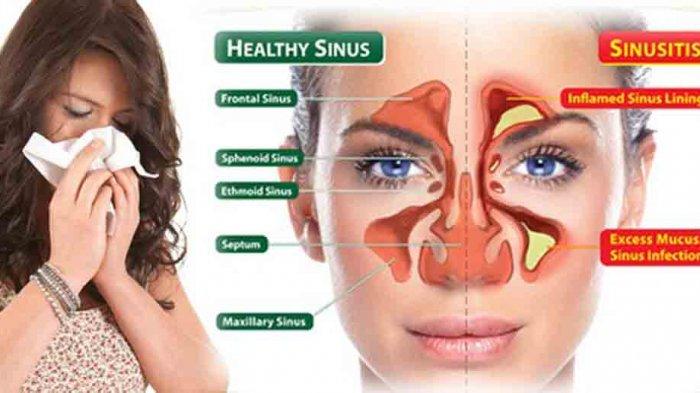 Detail Gambar Penyakit Sinusitis Nomer 8