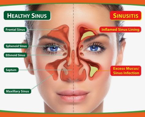 Detail Gambar Penyakit Sinusitis Nomer 9