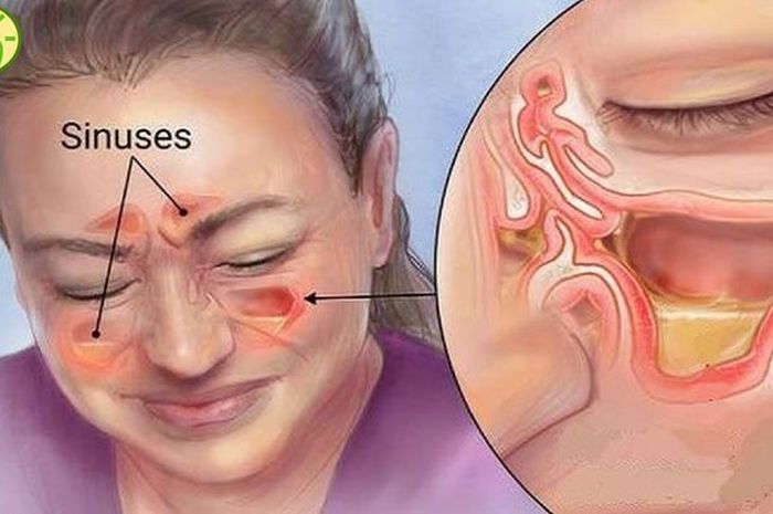 Detail Gambar Penyakit Sinusitis Nomer 10