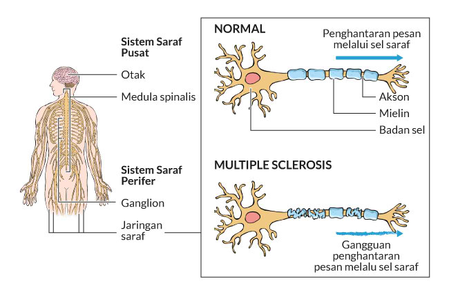 Gambar Penyakit Sklerosis - KibrisPDR