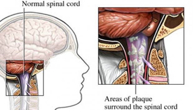 Detail Gambar Penyakit Sklerosis Nomer 2