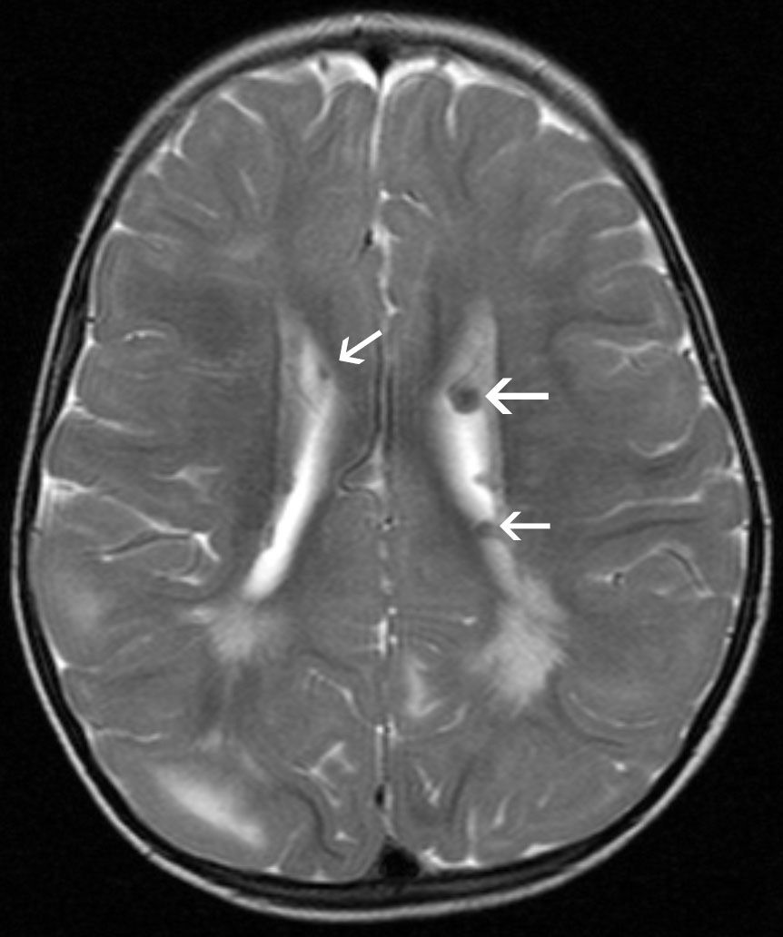 Detail Gambar Penyakit Sklerosis Nomer 39