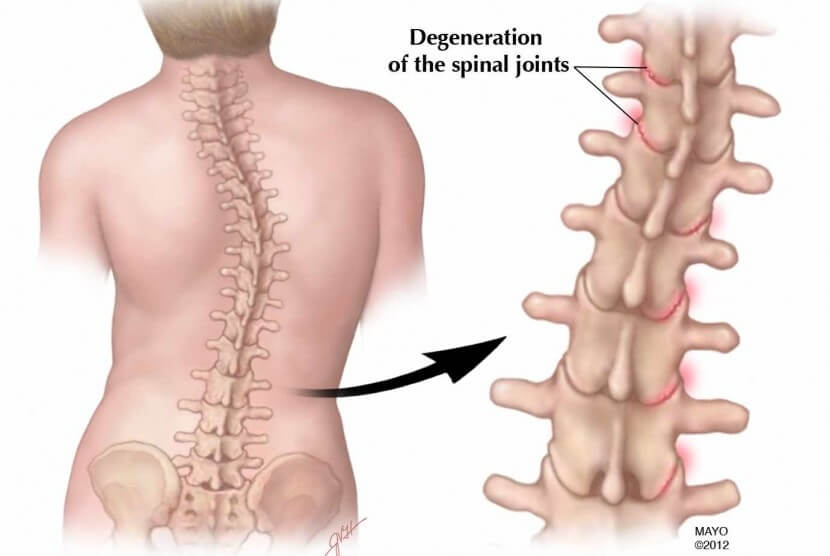 Detail Gambar Penyakit Skoliosis Nomer 12