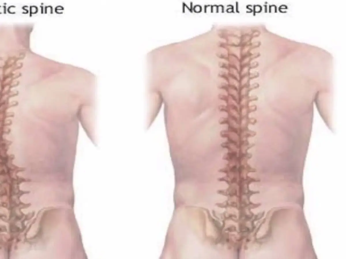 Detail Gambar Penyakit Skoliosis Nomer 13