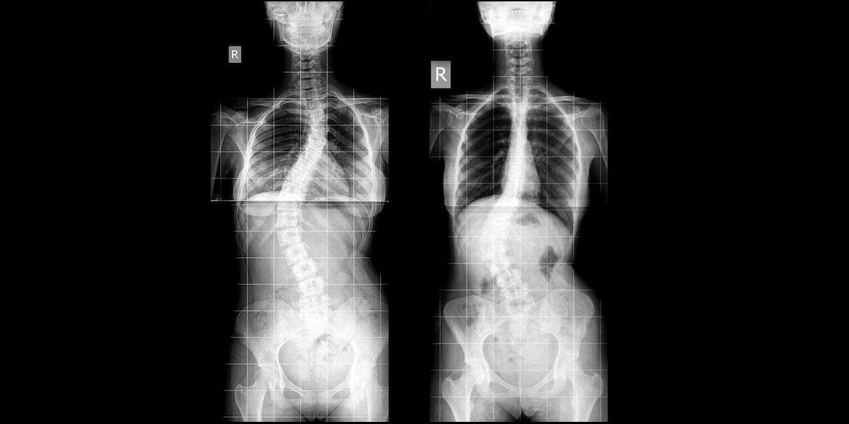 Detail Gambar Penyakit Skoliosis Nomer 30